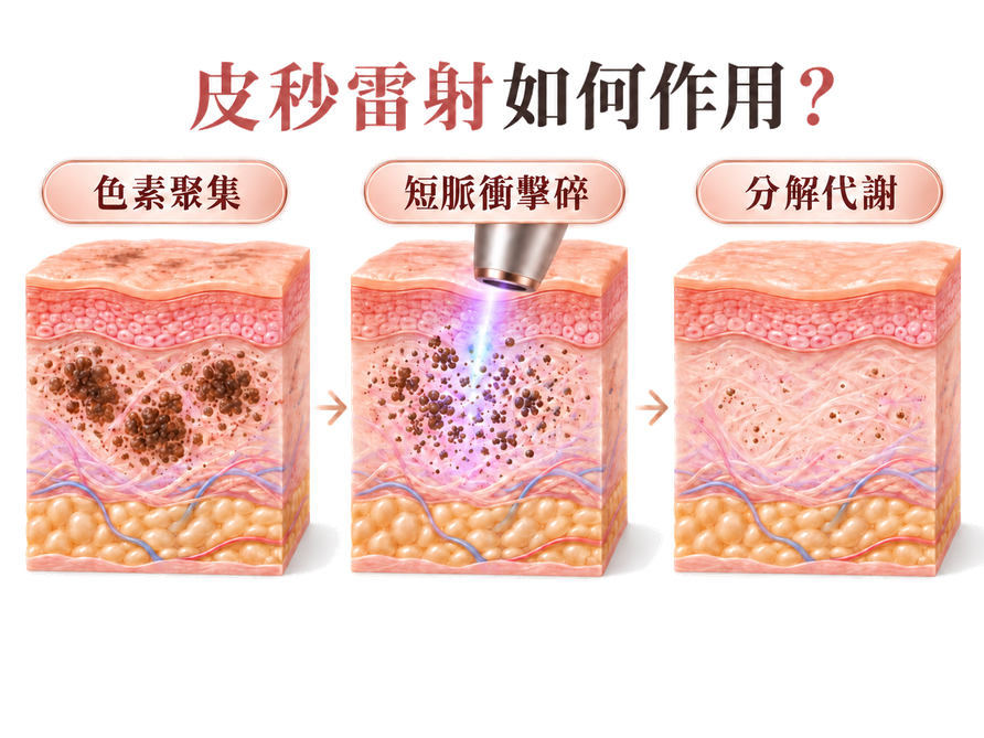 琢顏診所皮秒雷射作用原理示意圖