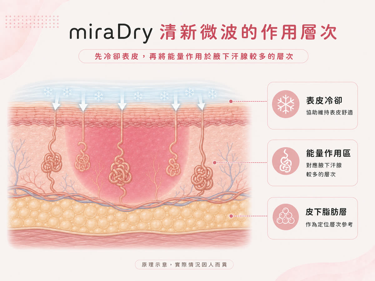 miraDry 清新微波表皮冷卻與汗腺目標層次示意圖